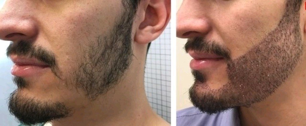 Сколько стоит пересадка бороды