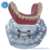 Macro Modelo Overdenture Mandíbula Acrílica Barra Clip + Prótese - Macro Modelos Odontológicos