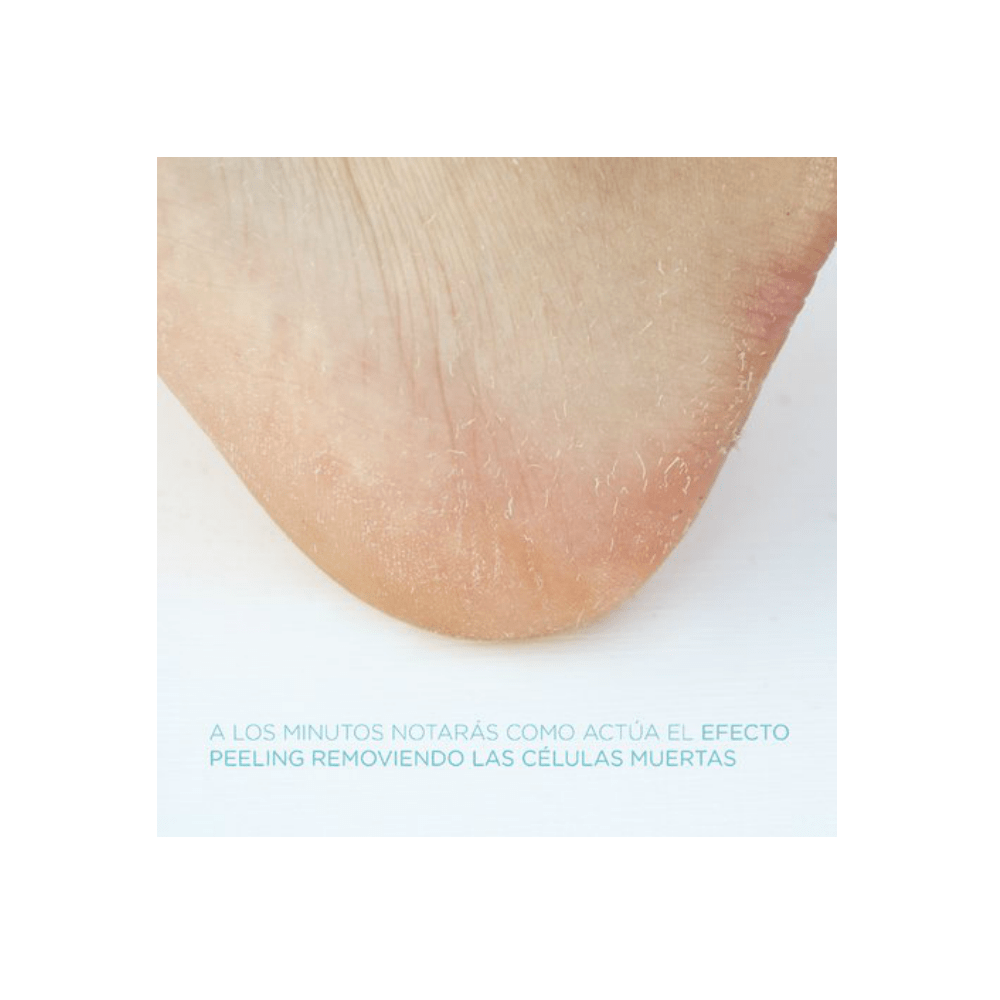 varicoza peeling